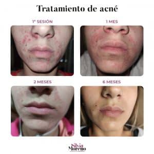 tratamiento-acne-resultados